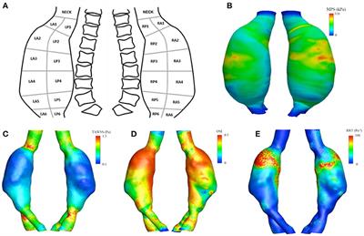 Case Study: Intra-Patient Heterogeneity of Aneurysmal Tissue Properties